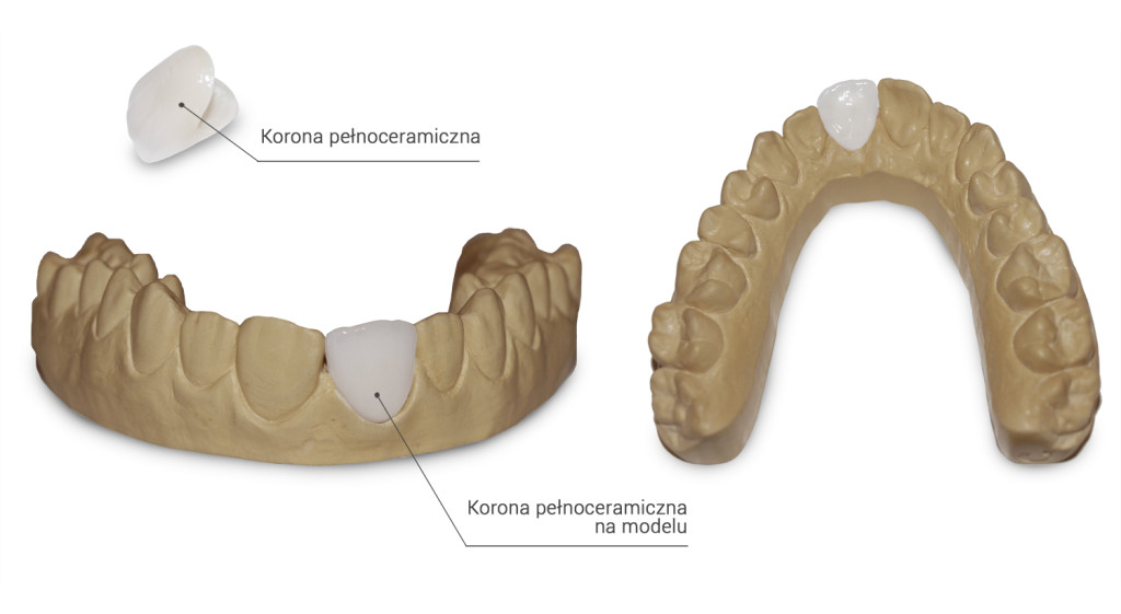 Korona pełnoceramiczna